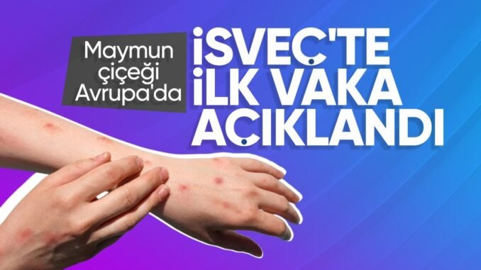 maymun-cicegi-virusu-isvecte-goruldu-DwF7dKc9.jpg