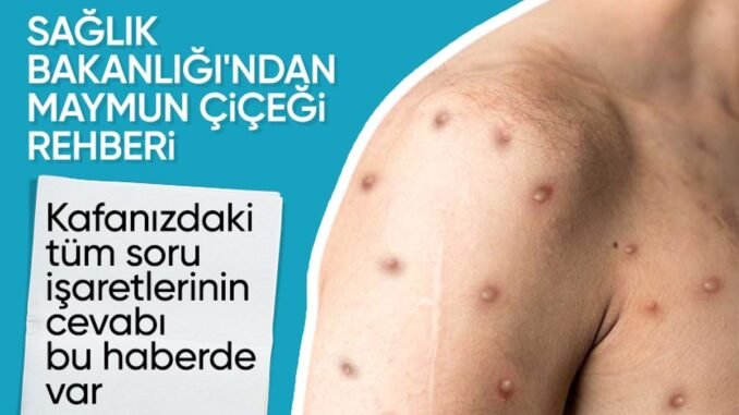 sihhat-bakanligindan-maymun-cicegi-rehberi-bilinmeyen-her-sey-sOvb2YRJ.jpg