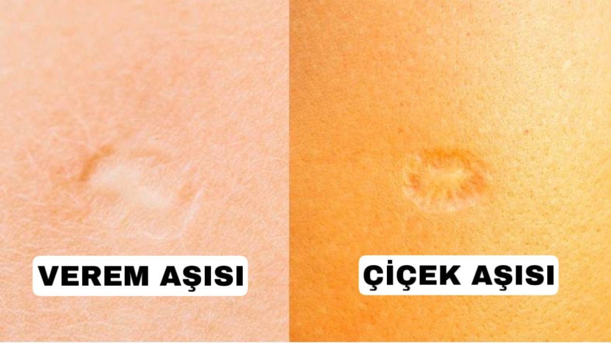 sol-omuzdaki-asi-izi-verem-mi-cicek-mi-cicek-asisi-izi-nasil-olur-iste-8qZsNEBS.jpg