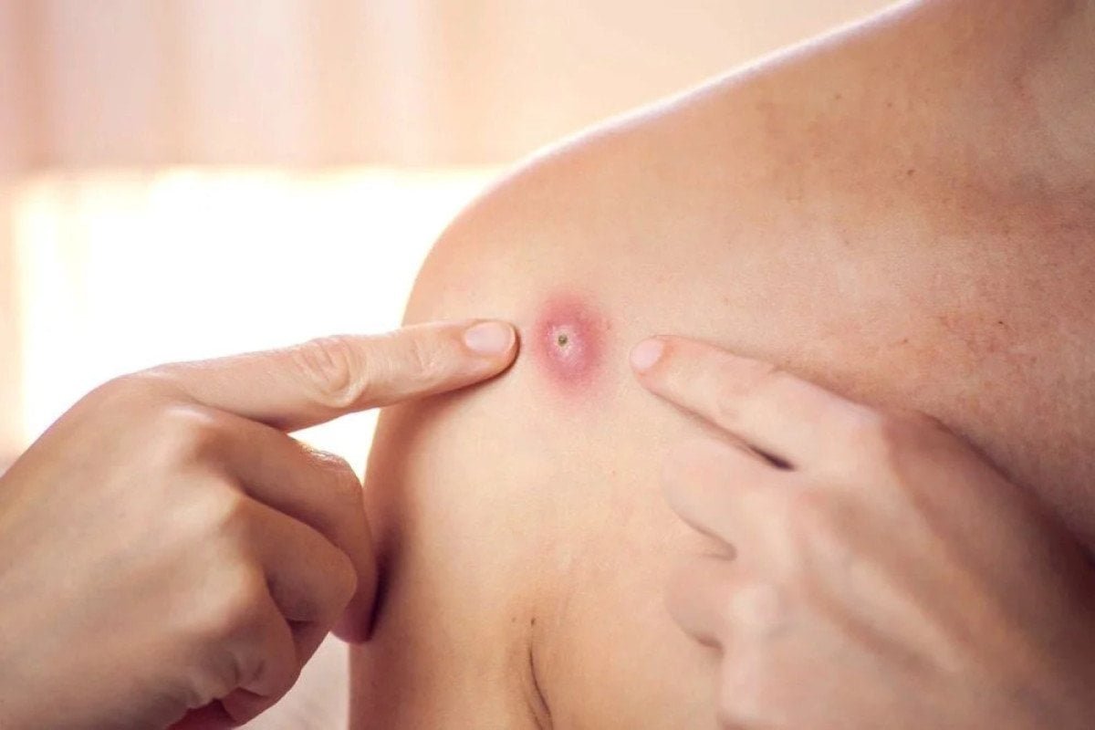 maymun-cicegi-mpox-hastaligi-hakkinda-bilgiler-0-siLMdMPD.jpg