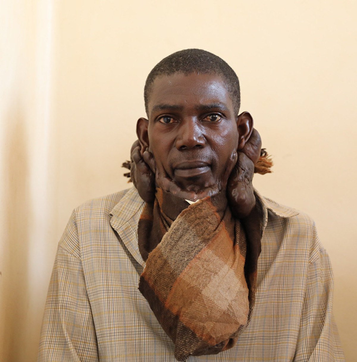turk-doktorlarin-ugandadaki-keloid-ameliyati-basarisi-3-8VZWX1FN.jpg