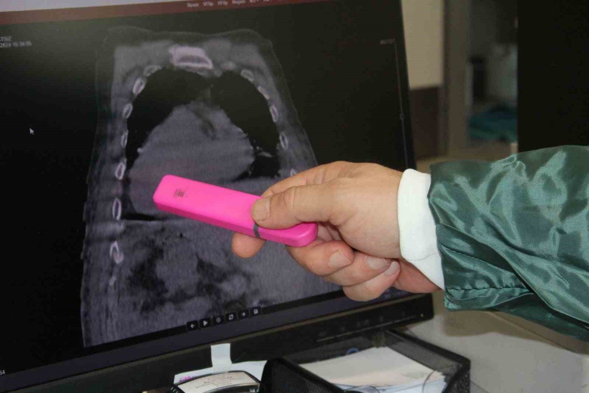 Giresun'da Nadir Bir Tıp Vakası: Giresun Sendromu